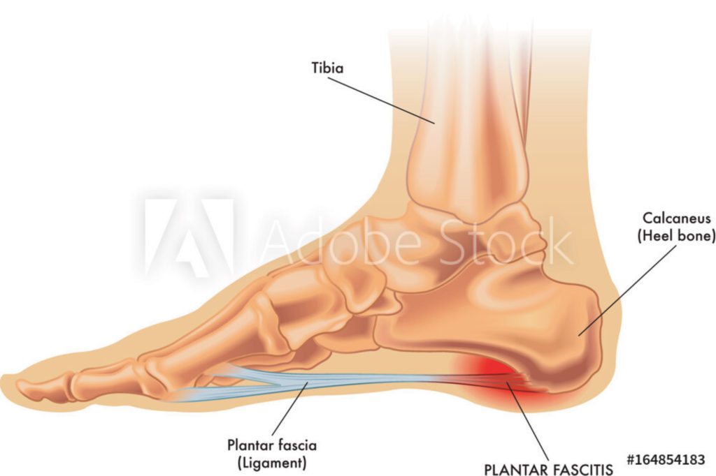 Plantar fasciitis inserts help relieve chronic foot pain.