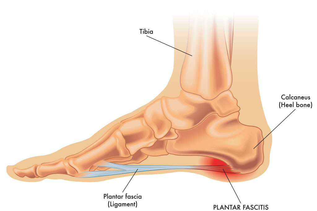 Foot diagram showing how plantar fasciitis shoe inserts relieve foot pain